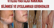 vitiligo hastalığı hakkında bilinmesi ve uygulanması gerekenler